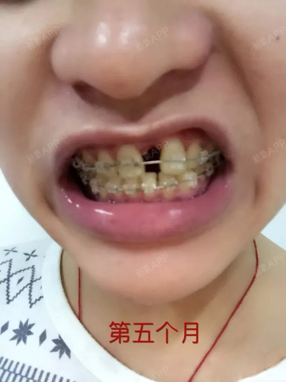 门牙在中间特效下载_(视频特效素材免费下载)